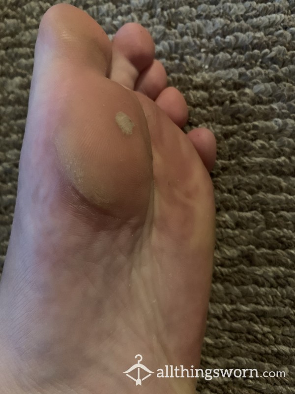 Calloused Soles