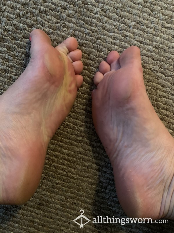 Callused Soles